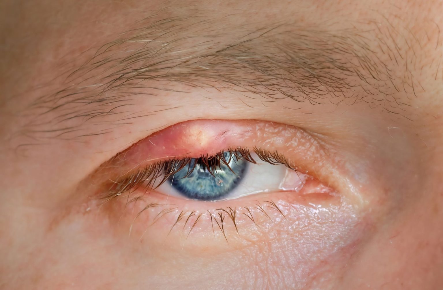 eyelid-bump-min-old-south-optometry