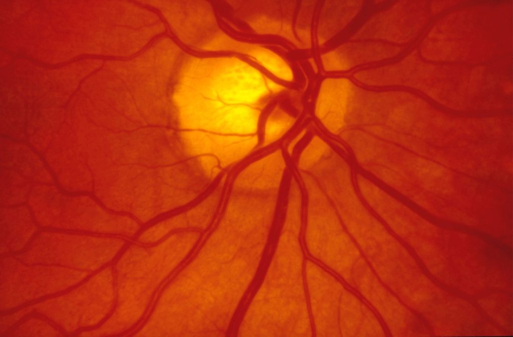 Fundus photography showing a very healthy back of a patient's eye.