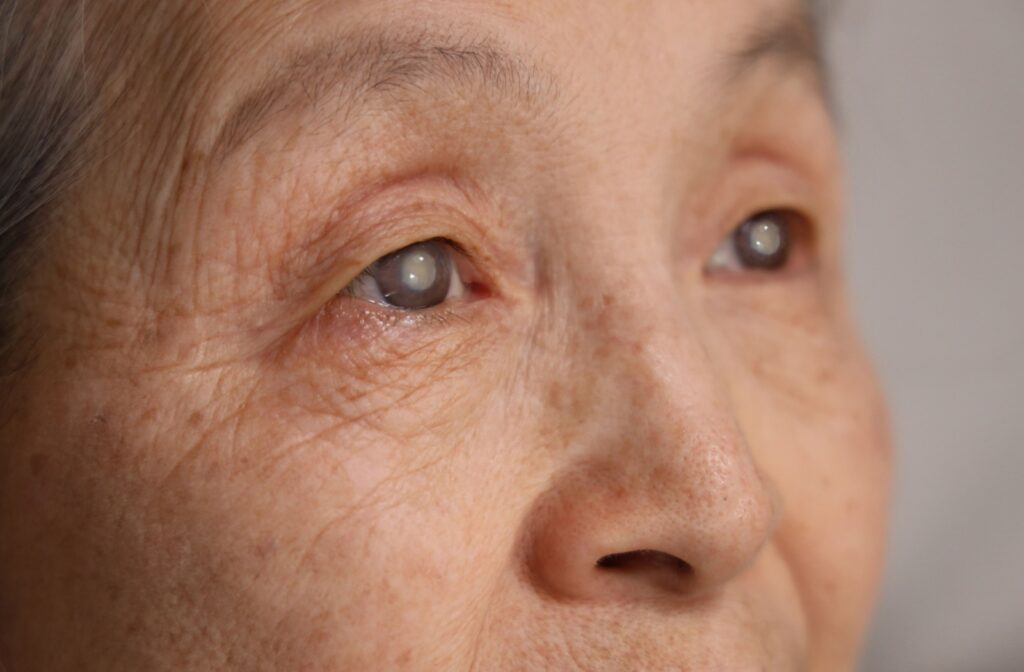Close-up of an older person's eyes whose pupils look grey and cloudy.